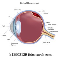 Retinal detachment, eps8 Retinal detachment, eps8