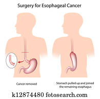 Surgery for esophageal cancer Surgery for esophageal cancer