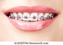 teeth with braces