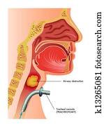 tracheotomy tracheotomy