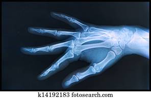 X-ray of two human hands with thumb and pointer fingers touching. Stock ...