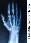 Xray of Hand/ fingers