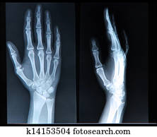 Xray of Hand/ fingers
