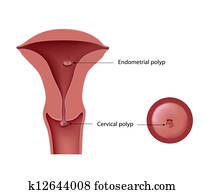 zervikal, und, endometrial, polypen zervikal, und, endometrial, polypen