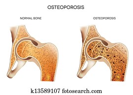 אוסטיאופורוזיס