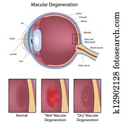 הבט, macular, התנוונות