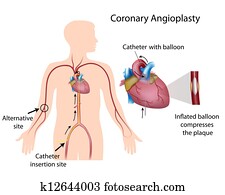 עורקי, angioplasty,, eps10