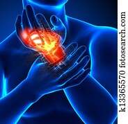 שורש היד, כאב, -, כאב, טראומה