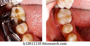שן, להתמלא, על ידי, רופא שניים