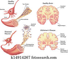 Alzheimer's disease Alzheimer's disease