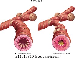 Asthma Asthma