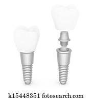 Dental implants Dental implants