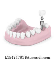 Dental implants Dental implants