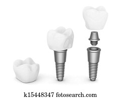 Dental implants Dental implants