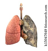 doença pulmão, before.and.after