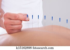 mulher, recebendo, um, terapia acupuntura