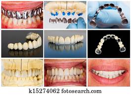Technical steps of dental bridge Technical steps of dental bridge