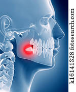 An impacted wisdom tooth An impacted wisdom tooth