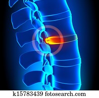 Bulging Disc Degeneration - Spine p Bulging Disc Degeneration - Spine p