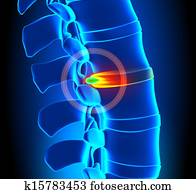 Herniated Disc Degeneration - Spine Herniated Disc Degeneration - Spine