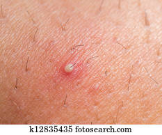 Ingrown Hair Closeup Stock Photograph K12708406 Fotosearch