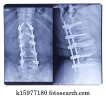 scoliosis,, רנטגן