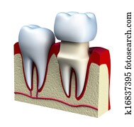 Dental crown installation process, Dental crown installation process,