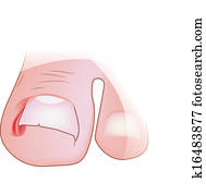 ingrown toenail ingrown toenail