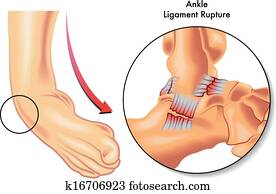 קרסול, מיתר, קרע