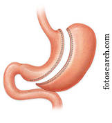 Sleeve gastrectomy procedure
