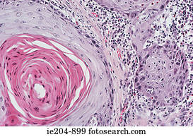 Squamous cell carcinoma