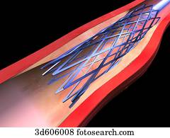Vascular stent has been fully extended and the balloon catheter is being removed. Expanded stent keeps artery lumen open. Vascular stent has been fully extended and the balloon catheter is being removed. Expanded stent keeps artery lumen open.