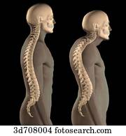 Kyphosis (right) vs. normal spinal column (left).