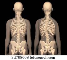 Scoliosis (right) vs. normal spinal column (left). Scoliosis (right) vs. normal spinal column (left).