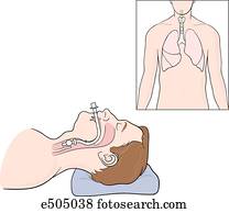 Main image shows how, when properly positioned, the cuff of the endotracheal tube should be just below the vocal cords.  Insert shows how the distal tip of the tube should be above the carina.
