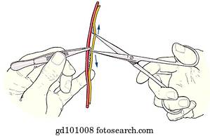 Scissors technique: separating delicate structures.