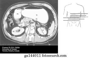 Transverse or horizontal (axial) MRI of the abdomen at the level of L1.  Image at bottom illustrates level of scan (line C).