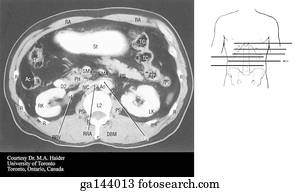 Transverse or horizontal (axial) MRI of the abdomen at the level of the lower L2.  Image at bottom illustrates level of scan (line E).