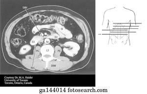 Transverse or horizontal (axial) MRI of the abdomen at the level of the lower L3.  Image at bottom illustrates level of scan (line F).