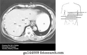 Transverse or horizontal (axial) MRI of the abdomen at the level of the xiphoid process and T11.  Image at bottom illustrates level of scan (line A).