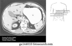Transverse or horizontal (axial) MRI of the abdomen at the level of T12.  Image at bottom illustrates level of scan (line B).