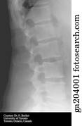 Lateral radiograph of the lumbar vertebrae.