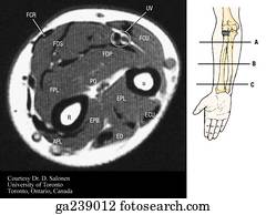 Radius & ulna Stock Illustration | h102064 | Fotosearch