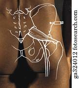 Posterior view of the gluteal region showing the gluteus medius muscle