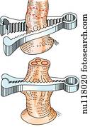 Illustration of procedure to apply umbilical clamp to umbilical cord.  Top:  clamp is in position, open; area to be cut indicated by dashed line.  Bottom:  clamp is closed, cord has been cut, three vessels are visible in cord. 