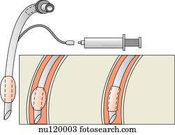 Clipart of Cuffed Endotracheal Tube etubcuf - Search Clip Art ...