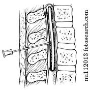 Sagittal section of lumbar area of spinal column showing pertinent anatomy. Needle inserted between vertebrae into cerebral spinal fluid (CSF). Sagittal section of lumbar area of spinal column showing pertinent anatomy. Needle inserted between vertebrae into cerebral spinal fluid (CSF).