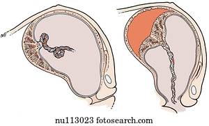 Stock Illustration of Sagittal section of uterus shortly after birth of ...