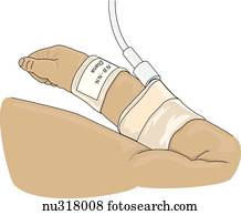 Arm of infant shown wearing name tag on wrist with IV in place. 