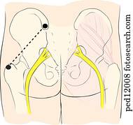 技術 ために 筋肉内 注入 中に 子供 Dorsogluteal Site